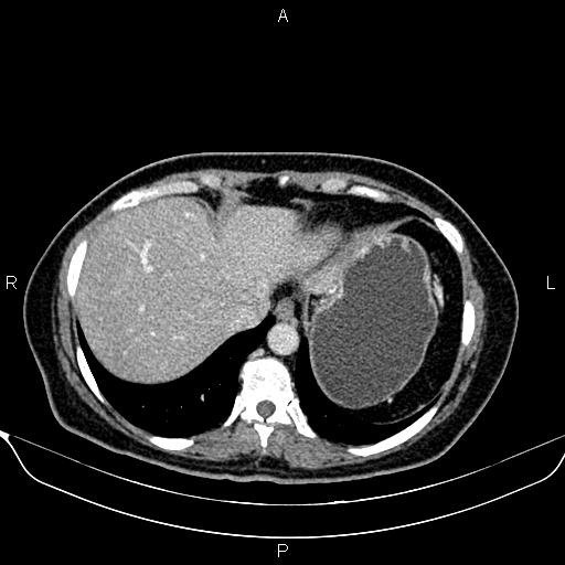 Bilateral benign adrenal adenomas (Radiopaedia 86912-103124 B 18).jpg