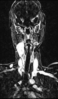 Bilateral carotid body tumors and right glomus jugulare tumor (Radiopaedia 20024-20060 MRA 90).jpg