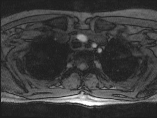 File:Bilateral carotid body tumors and right jugular paraganglioma (Radiopaedia 20024-20060 Axial 284).jpg