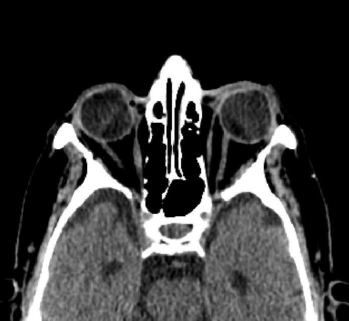 Bilateral ectopia lentis (Radiopaedia 89889-107013 Axial non-contrast 44).jpg