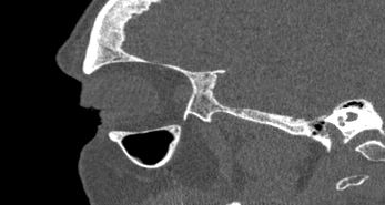 File:Bilateral ectopic infraorbital nerves (Radiopaedia 49006-54084 Sagittal 37).png