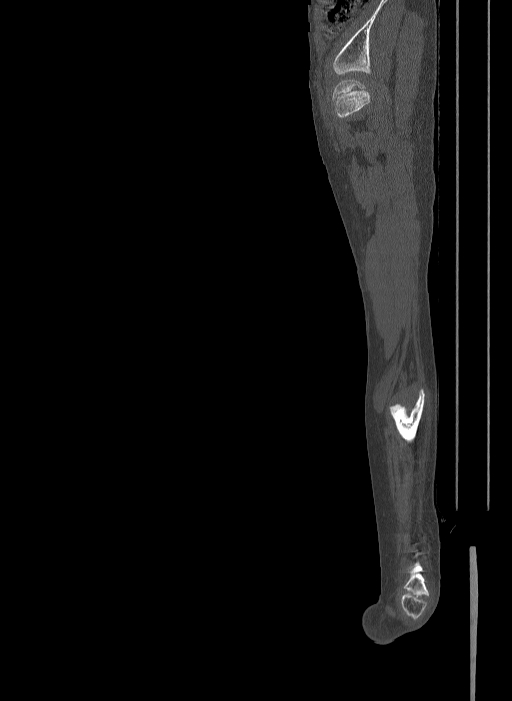 Bilateral fibular hemimelia type II (Radiopaedia 69581-79491 Sagittal bone window 30).jpg