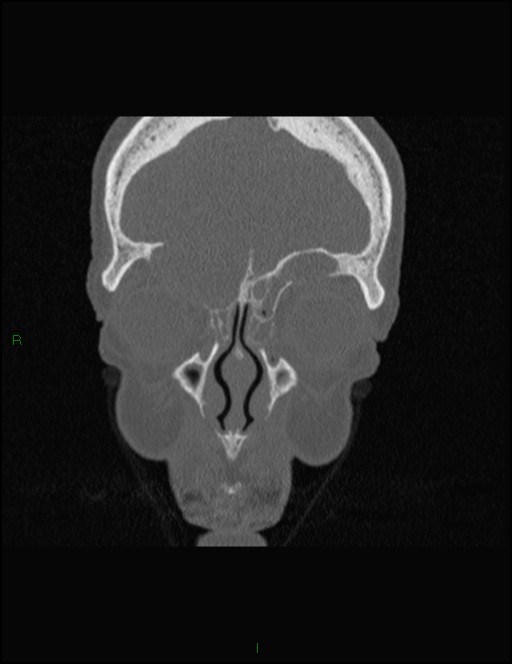 Bilateral frontal mucoceles (Radiopaedia 82352-96454 Coronal 88).jpg