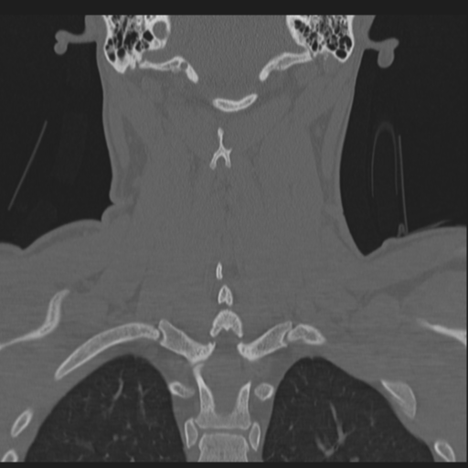 Bilateral locked facets (Radiopaedia 33850-35016 Coronal bone window 63).png