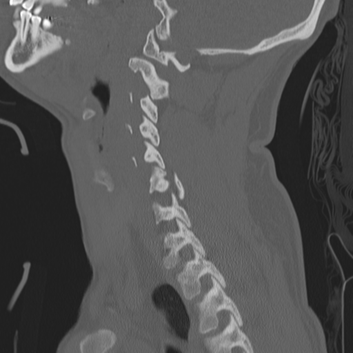 Bilateral locked facets (Radiopaedia 33850-35016 Sagittal bone window 32).png