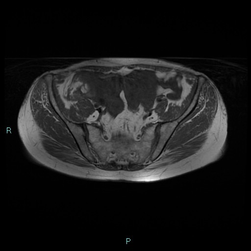 File:Bilateral ovarian fibroma (Radiopaedia 44568-48293 Axial T1 8).jpg