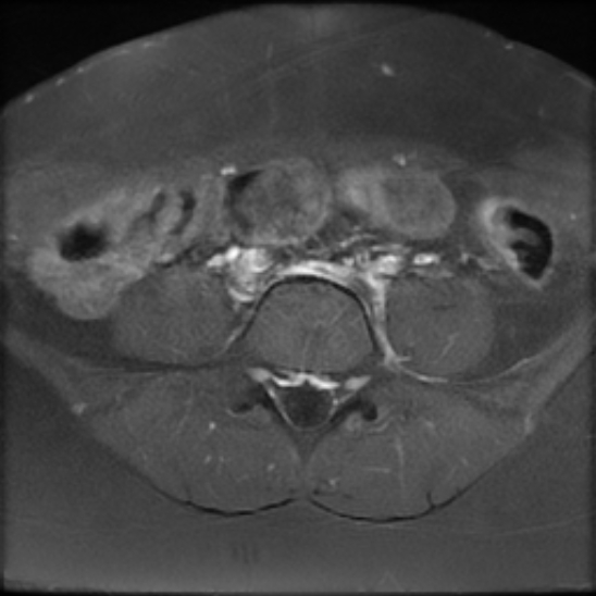 File:Bilateral ovarian fibrothecomas - adolescent (Radiopaedia 86604-102707 Axial T1 C+ fat sat 2).jpg