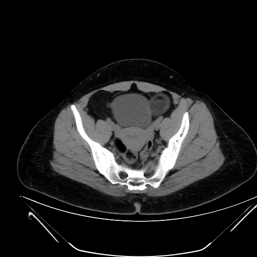 Bilateral ovarian mature cystic teratomas (Radiopaedia 79373-92457 Axial non-contrast 60).jpg