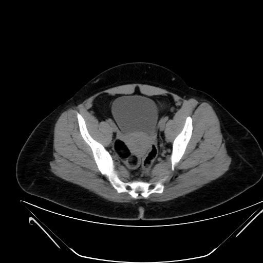 Bilateral ovarian mature cystic teratomas (Radiopaedia 79373-92457 Axial non-contrast 63).jpg