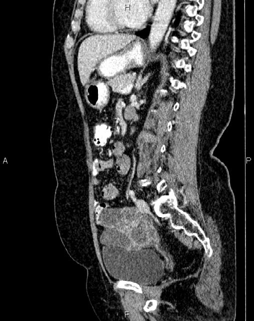 Bilateral ovarian serous cystadenocarcinoma (Radiopaedia 86062-101989 E 51).jpg