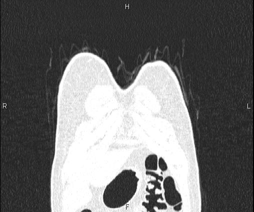 File:Bilateral pulmonary AVM (Radiopaedia 83134-97505 Coronal lung window 11).jpg