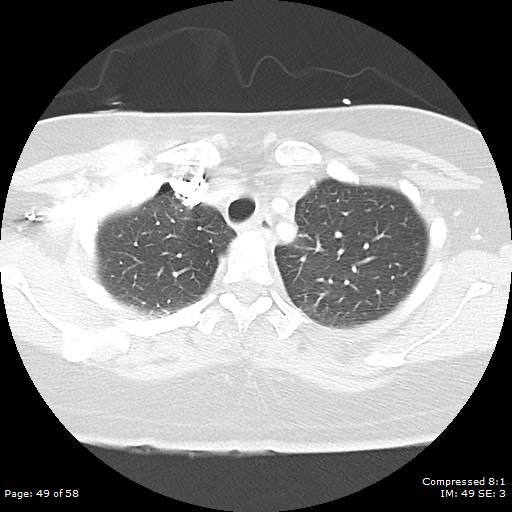Bilateral pulmonary emboli with Hampton hump sign (Radiopaedia 54070-60246 Axial lung window 49).jpg
