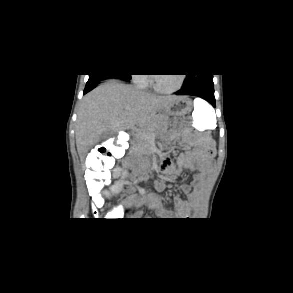 File:Bilateral renal malrotation (Radiopaedia 30901-31606 B 48).jpg