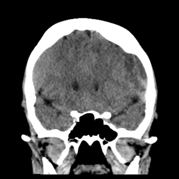 Bilateral subdural hemorrhages (Radiopaedia 26588-26732 Coronal non-contrast 23).jpg