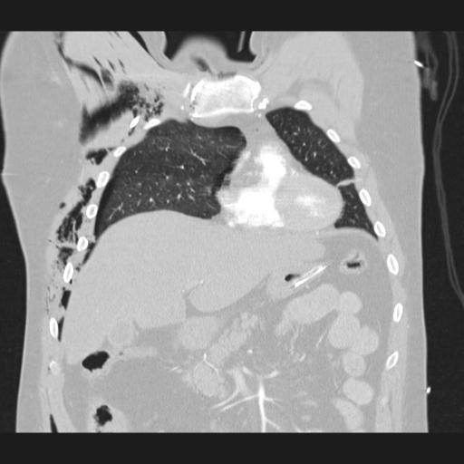 Bilateral traumatic renovascular injury (Radiopaedia 32051-32995 Coronal lung window 25).jpg