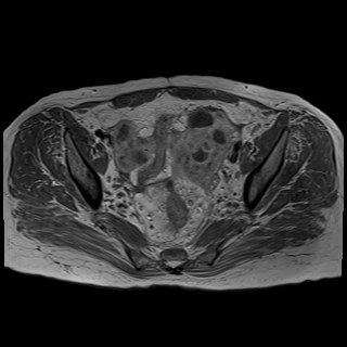 Bilateral tubo-ovarian abscesses (Radiopaedia 58635-65829 Axial T1 C+ 24).jpg
