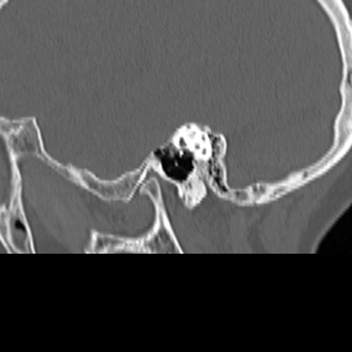 Bilateral tympanoplasty (Radiopaedia 16947-16664 Sagittal bone window 26).jpg