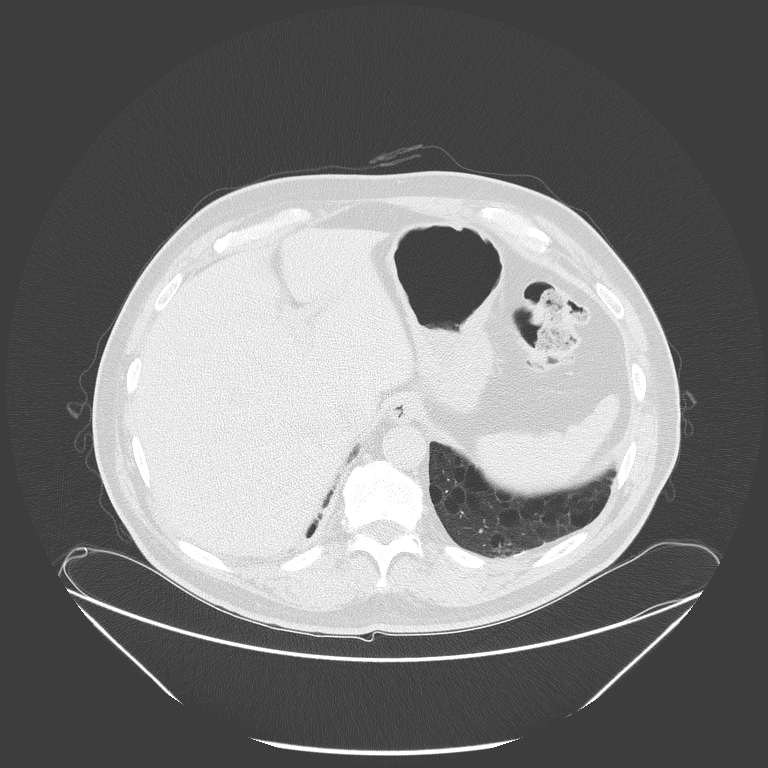 Birt-Hogg-Dubé syndrome (Radiopaedia 52578-58491 Axial lung window 57).jpg