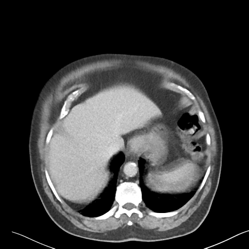 File:Bladder papillary urothelial carcinoma (Radiopaedia 48119-52951 Axial 3).png
