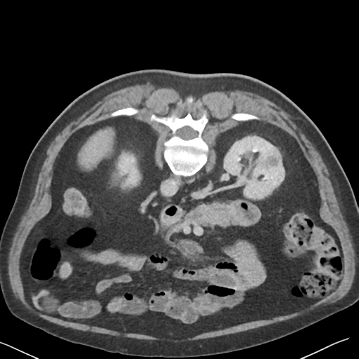 File:Bladder papillary urothelial carcinoma (Radiopaedia 48119-52951 Axial C+ delayed 16).png