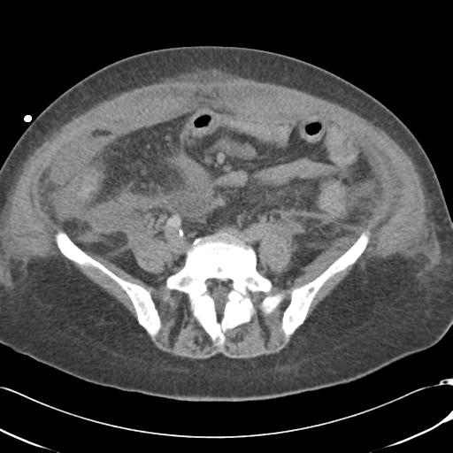 Bladder rupture post renal biopsy (Radiopaedia 30863-31572 Axial non-contrast 58).jpg