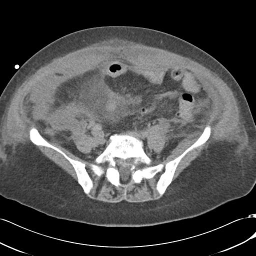 Bladder rupture post renal biopsy (Radiopaedia 30863-31572 Axial non-contrast 59).jpg