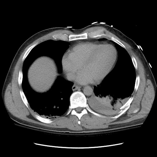 Blunt abdominal trauma with solid organ and musculoskelatal injury with active extravasation (Radiopaedia 68364-77895 Axial C+ delayed 10).jpg
