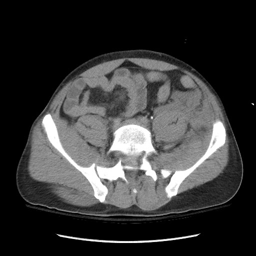 Blunt abdominal trauma with solid organ and musculoskelatal injury with active extravasation (Radiopaedia 68364-77895 Axial C+ delayed 100).jpg