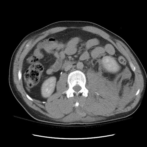 Blunt abdominal trauma with solid organ and musculoskelatal injury with active extravasation (Radiopaedia 68364-77895 Axial C+ delayed 65).jpg