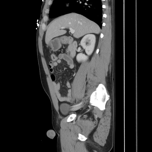 File:Blunt abdominal trauma with solid organ and musculoskelatal injury with active extravasation (Radiopaedia 68364-77895 C 58).jpg