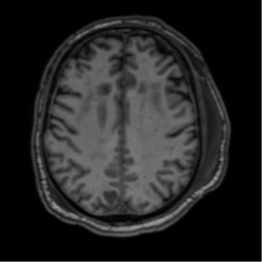 File:Blunt cerebrovascular injury (Radiopaedia 53682-59745 Axial T1 22).png