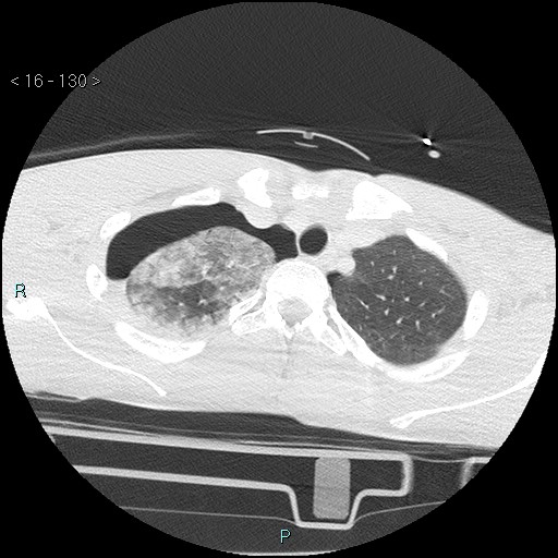 Blunt chest trauma (Swiss cheese sign) (Radiopaedia 38519-40618 Axial lung window 10).jpg