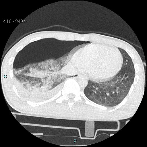 Blunt chest trauma (Swiss cheese sign) (Radiopaedia 38519-40618 Axial lung window 58).jpg