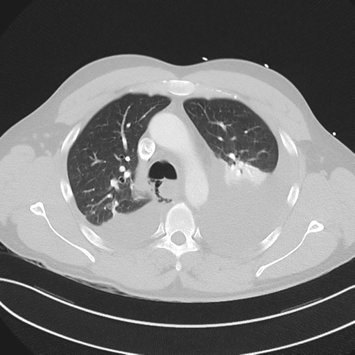 Boerhaave syndrome (Radiopaedia 39382-41660 Axial lung window 19).png