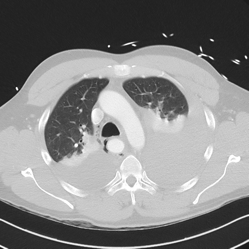 Boerhaave syndrome (Radiopaedia 39382-41661 Axial lung window 18).png