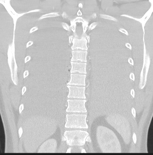 Boerhaave syndrome (Radiopaedia 39382-41661 Coronal lung window 39).png