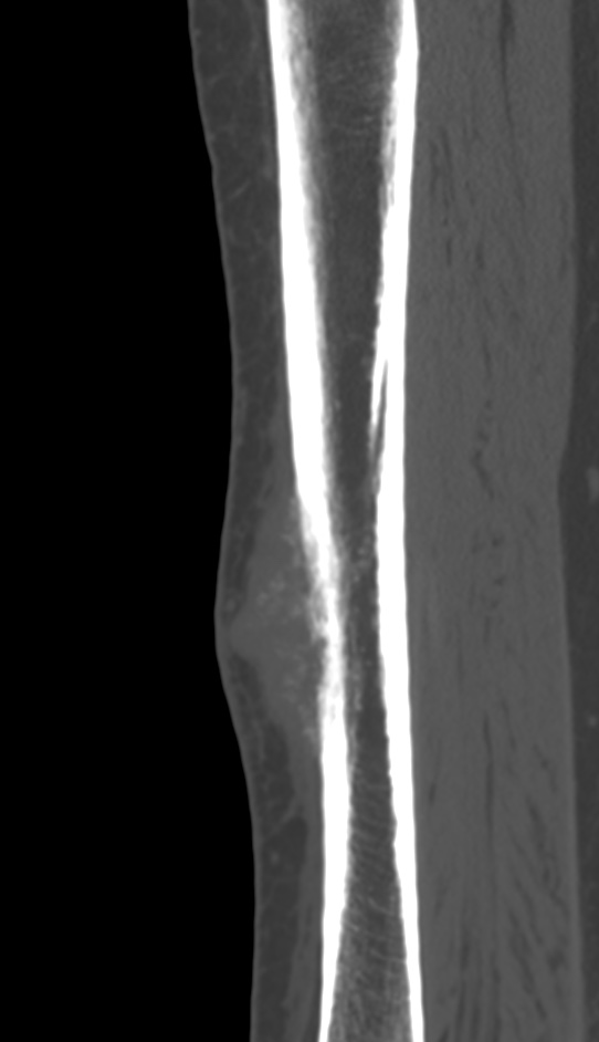 Bone metastasis - tibia (Radiopaedia 57665-64609 Sagittal bone window 72).jpg