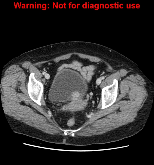 File:Bosniak renal cyst - type II (Radiopaedia 23404-23468 D 65).jpg
