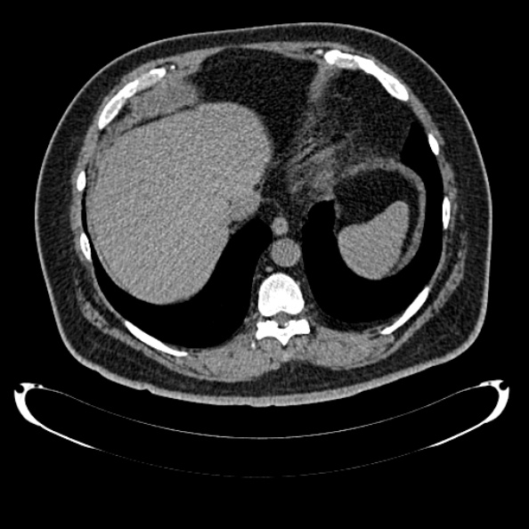 Bosniak renal cyst - type IV (Radiopaedia 24244-24518 Axial non-contrast 46).jpg