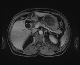 Bouveret syndrome (Radiopaedia 61017-68856 Axial T1 C+ fat sat 30).jpg