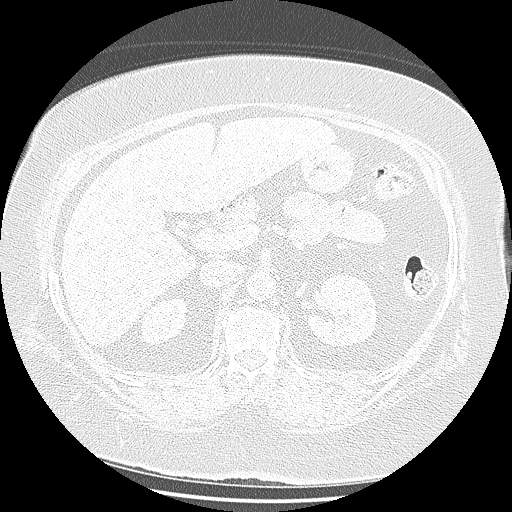 Bovine aortic arch - right internal mammary vein drains into the superior vena cava (Radiopaedia 63296-71875 Axial lung window 201).jpg
