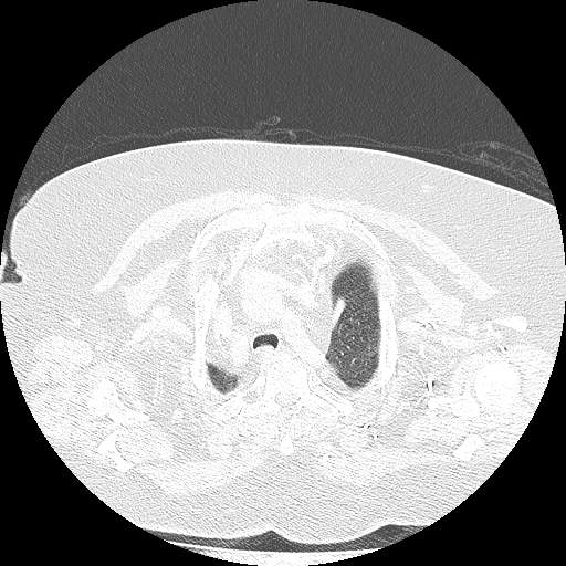 Bovine aortic arch - right internal mammary vein drains into the superior vena cava (Radiopaedia 63296-71875 Axial lung window 24).jpg