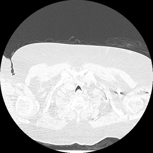 Bovine aortic arch - right internal mammary vein drains into the superior vena cava (Radiopaedia 63296-71875 Axial lung window 6).jpg