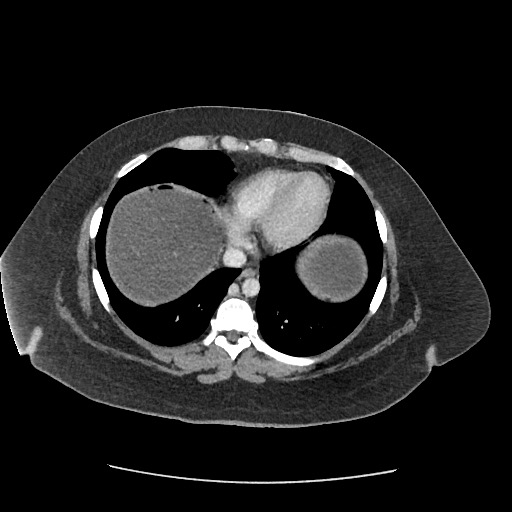 File:Bowel and splenic infarcts in acute lymphocytic leukemia (Radiopaedia 61055-68915 A 16).jpg