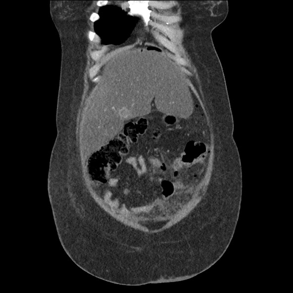 Bowel and splenic infarcts in acute lymphocytic leukemia (Radiopaedia 61055-68915 B 15).jpg