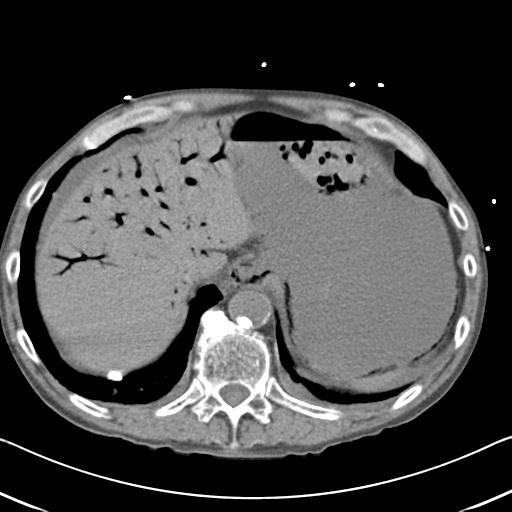 Bowel infarction (Radiopaedia 30296-30933 Axial non-contrast 12).jpg