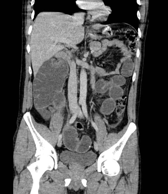 Bowel obstruction from colon carcinoma (Radiopaedia 22995-23028 C 37).jpg