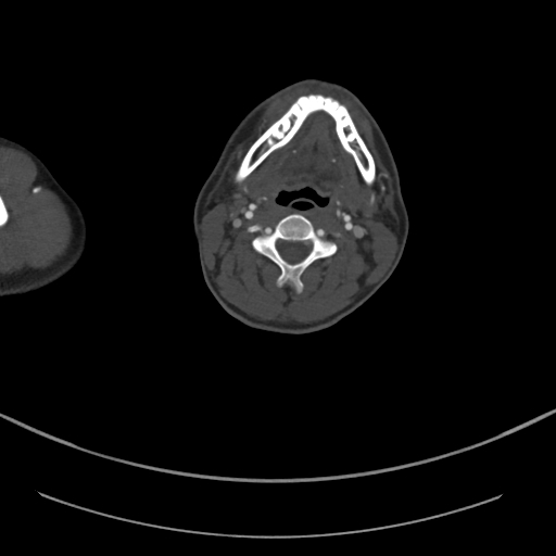Brachiocephalic trunk pseudoaneurysm (Radiopaedia 70978-81191 Axial bone window 12).jpg