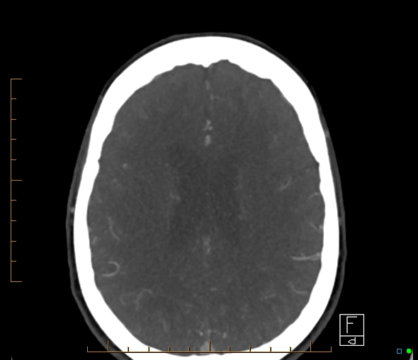 Brachiocephalic trunk stenosis (Radiopaedia 87242-103519 A 24).jpg