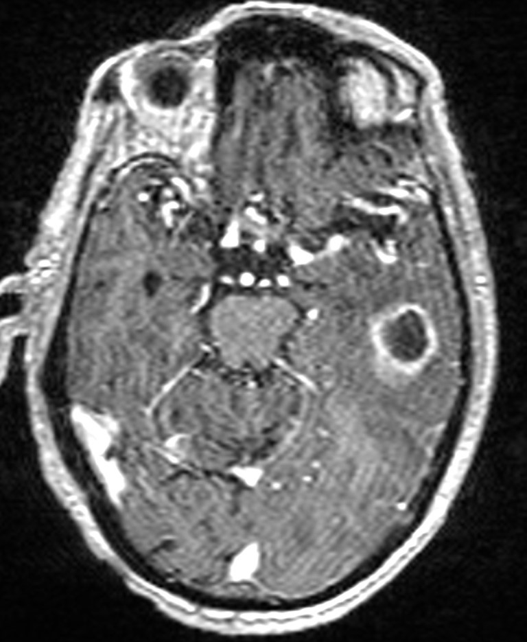 Brain abscess with dual rim sign (Radiopaedia 87566-103938 Axial T1 C+ 65).jpg